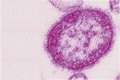 El sarampión es una enfermedad viral muy contagiosa que puede tener curso grave o fatal y causar secuelas permanentes