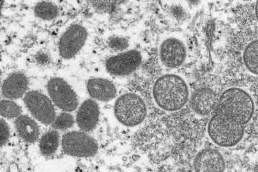 La cepa del virus que circula actualmente parece ser del tipo más leve de África que comienza con síntomas parecidos a los de la gripe.