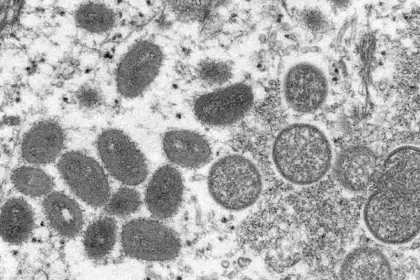 Este es el único caso informado de coinfección por el virus de la viruela del mono, Covid-19 y VIH.
