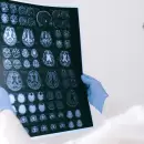Desarrollan un sistema de Inteligencia Artificial para el diagnstico temprano de las enfermedades neurolgicas