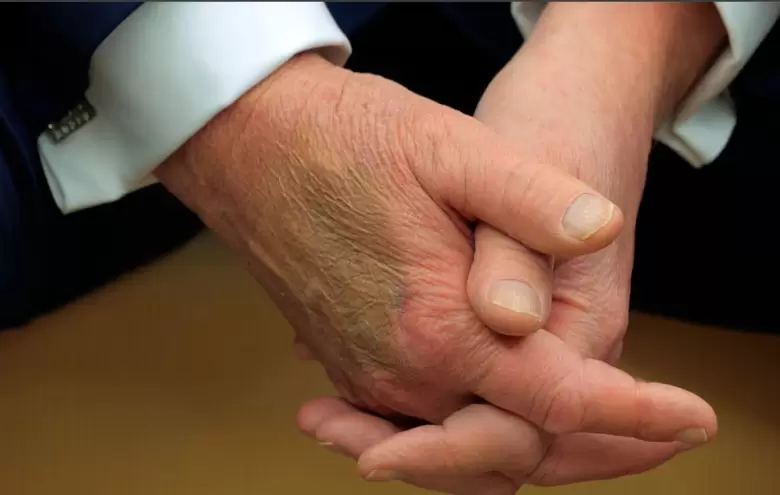 El maquillaje cubre un moretón en el dorso de la mano de Trump. Fue en febrero, cuando recibió a Macron.