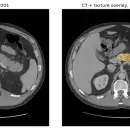 La IA logra anticipar el cáncer y abre una nueva esperanza